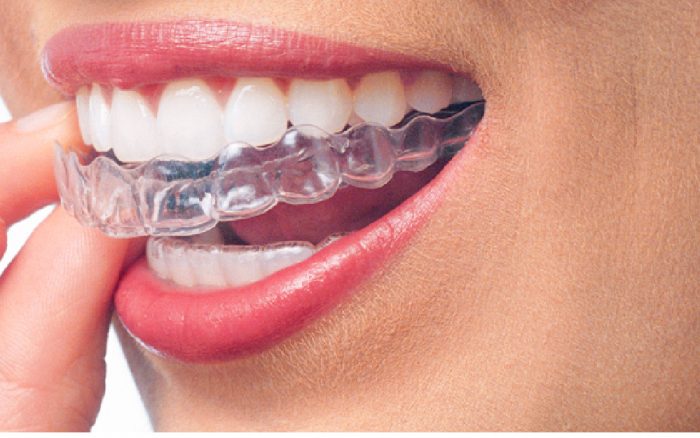 Invisalign Orthodontist